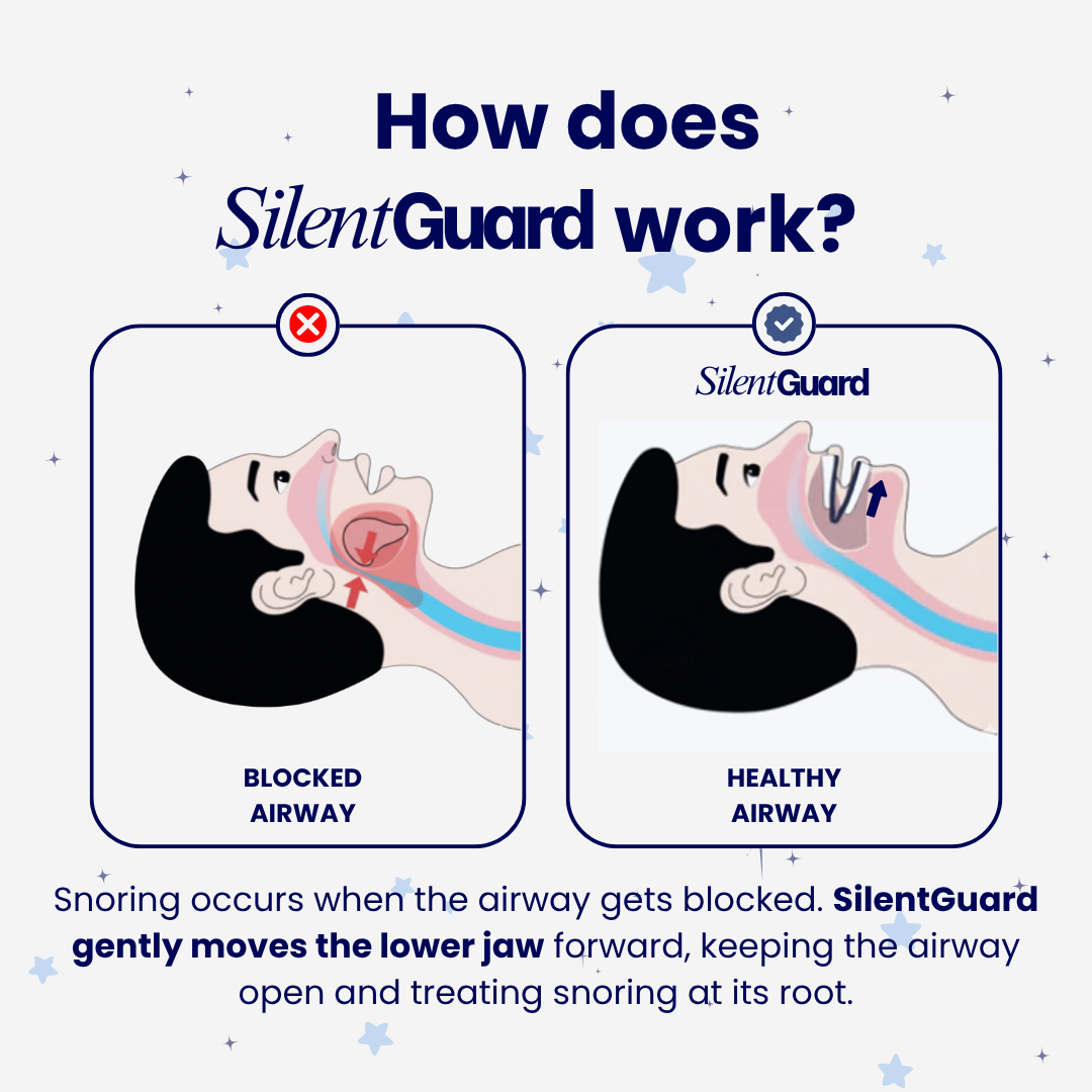 SilentGuard Pro® Anti-Snoring Mouthpiece